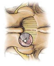 minimally invasive Spinal Stenosis Surgery
