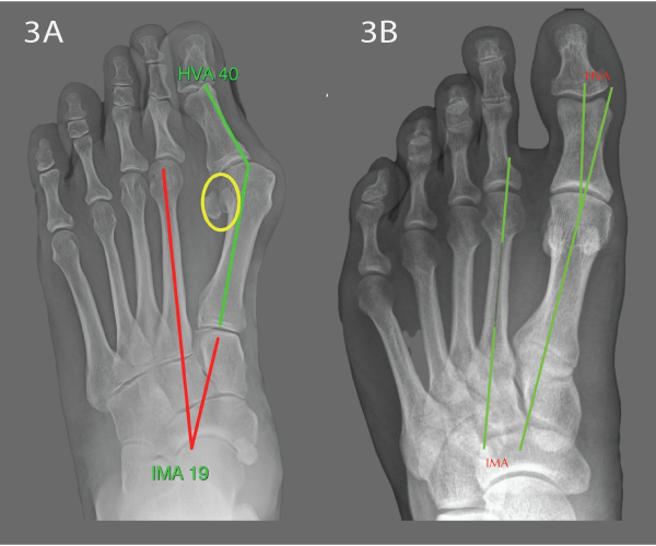 Xray of a normal and a bunion foot