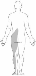 sciatica pain location