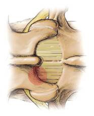 Laminotomy Spinal Stenosis Surgery
