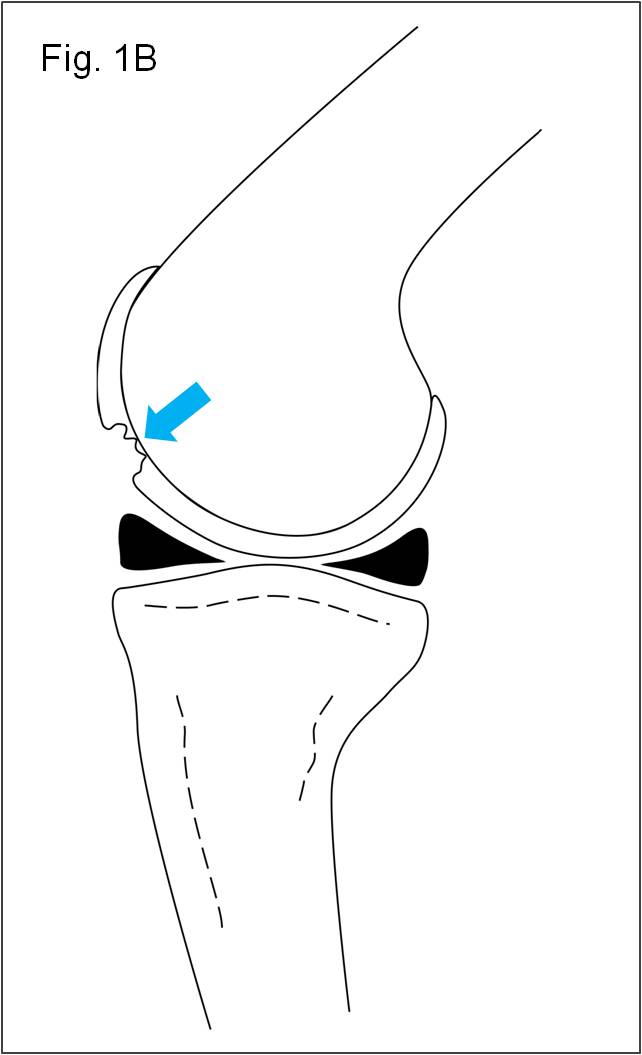 膝關節軟骨損傷常見問題 膝部 醫生文章 亞洲專科醫生