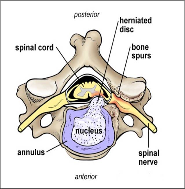 Cervical Degenerative Disc Disease with leakage of jelly