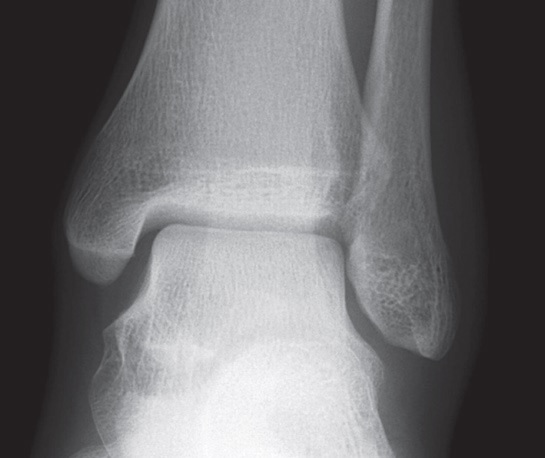 足踝扭傷常見問題 足部及踝部 醫生文章 亞洲專科醫生