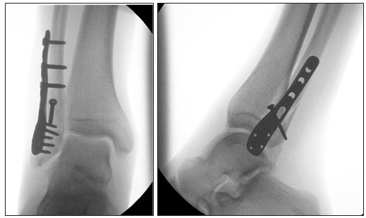 踝关节骨折常见问题 足部及踝部 医生文章 亚洲专科医生