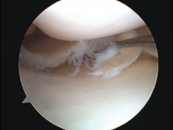 Arthroscopic view of a meniscus tear