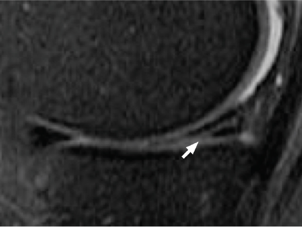 MRI image for an meniscus tear