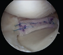 Meniscus Scaffold for meniscus regeneration