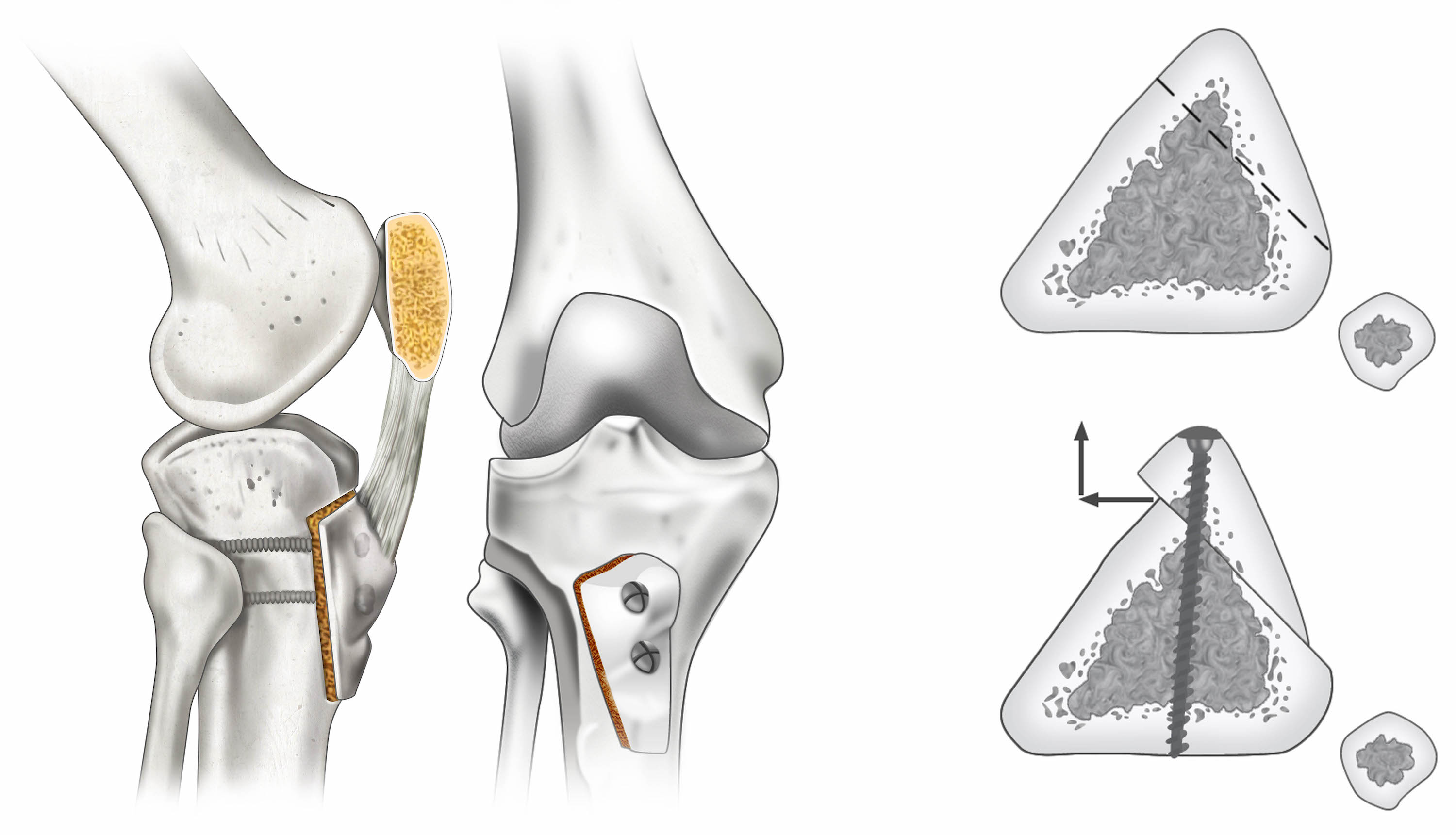 Fulkerson Osteotomy