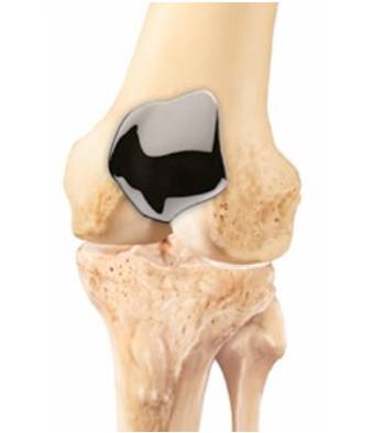 Left partial knee replacement