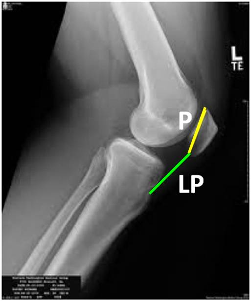X ray of a normal patella with normal install-salvati ratio