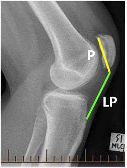 X ray result of a patella alta