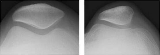 X ray comparison of a normal and dysplastic trochlea and patella