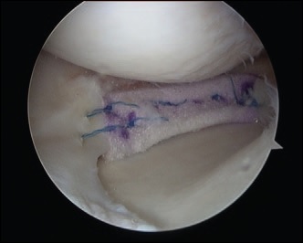 半月板常見問題撕裂 修復及移植 膝部 醫生文章 亞洲專科醫生