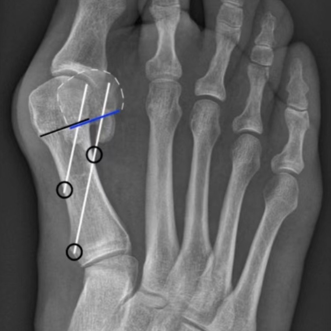 Fig7b-Chevron Osteotomy