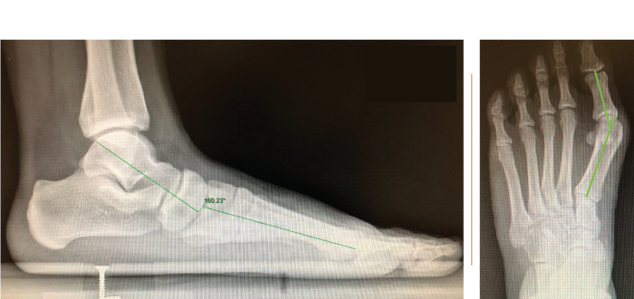 Flat foot associated with Hallux values