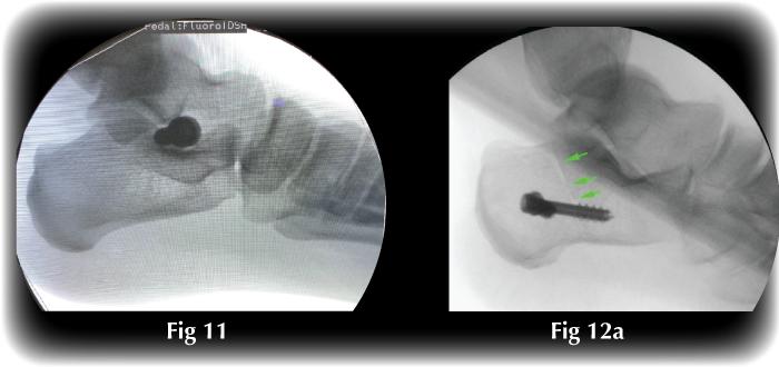 Arthroeresis and Calcaneal osteotomy