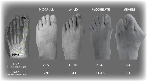 classification of bunions