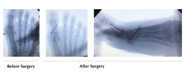 X-ray of a Bunion Surgery