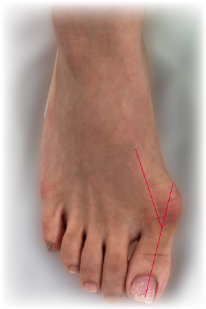 HALLUX VALGUS