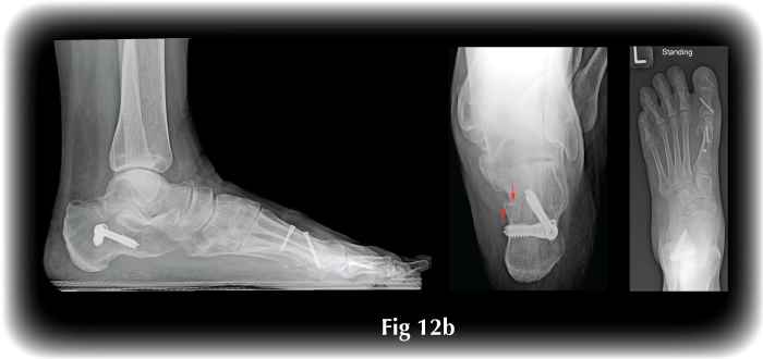 Bunion Post surgery after Calcaneal osteotomy