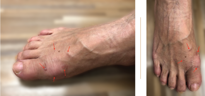 Post Bunion Surgery minimal scar