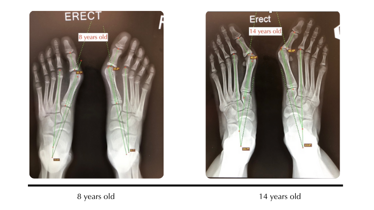 Post Bunion Surgery minimal scar