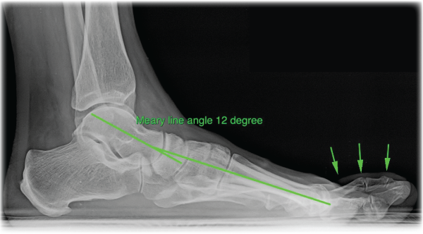 Weight bearing lateral X ray of foot