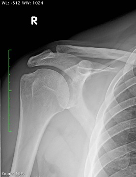 normal shoulder x ray