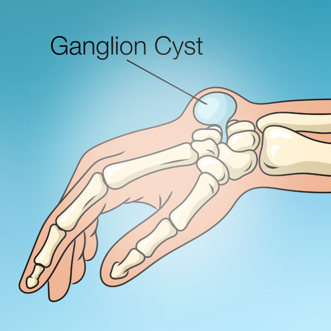 Gangloin-cyst