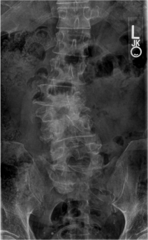 Fig 1 Degenerative Scoliosis