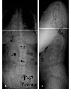 Fig 4. X-ray whole Spine AP/LAT on Standing