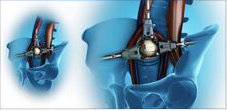 Fig 7. Direct Lateral Lumbar Interbody Fusion or Extreme Lateral Lumbar Interbody Fusion (DLIF/XLIF)