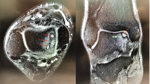 Ankle Joint Cartilage damage 