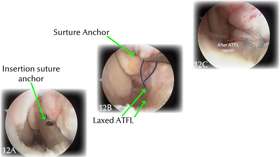 Arthroscopic Surgery