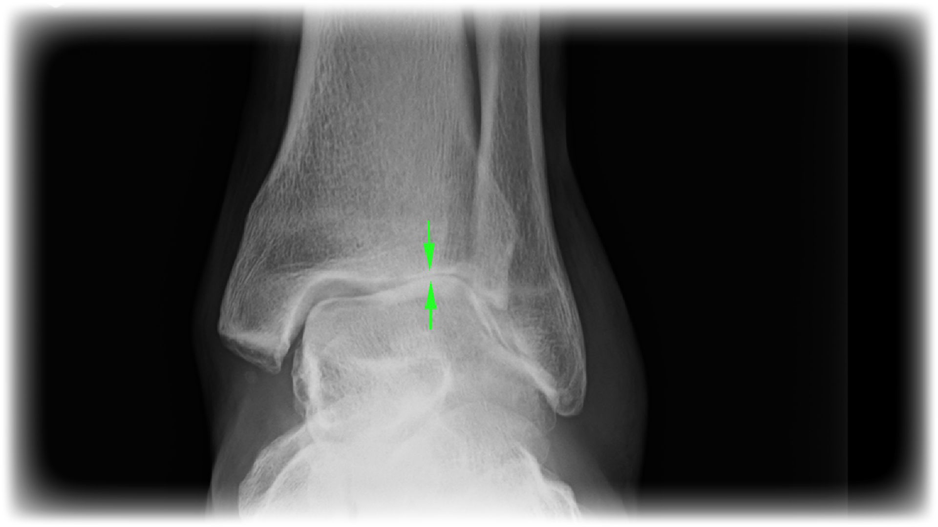 Osteoarthritis Ankle