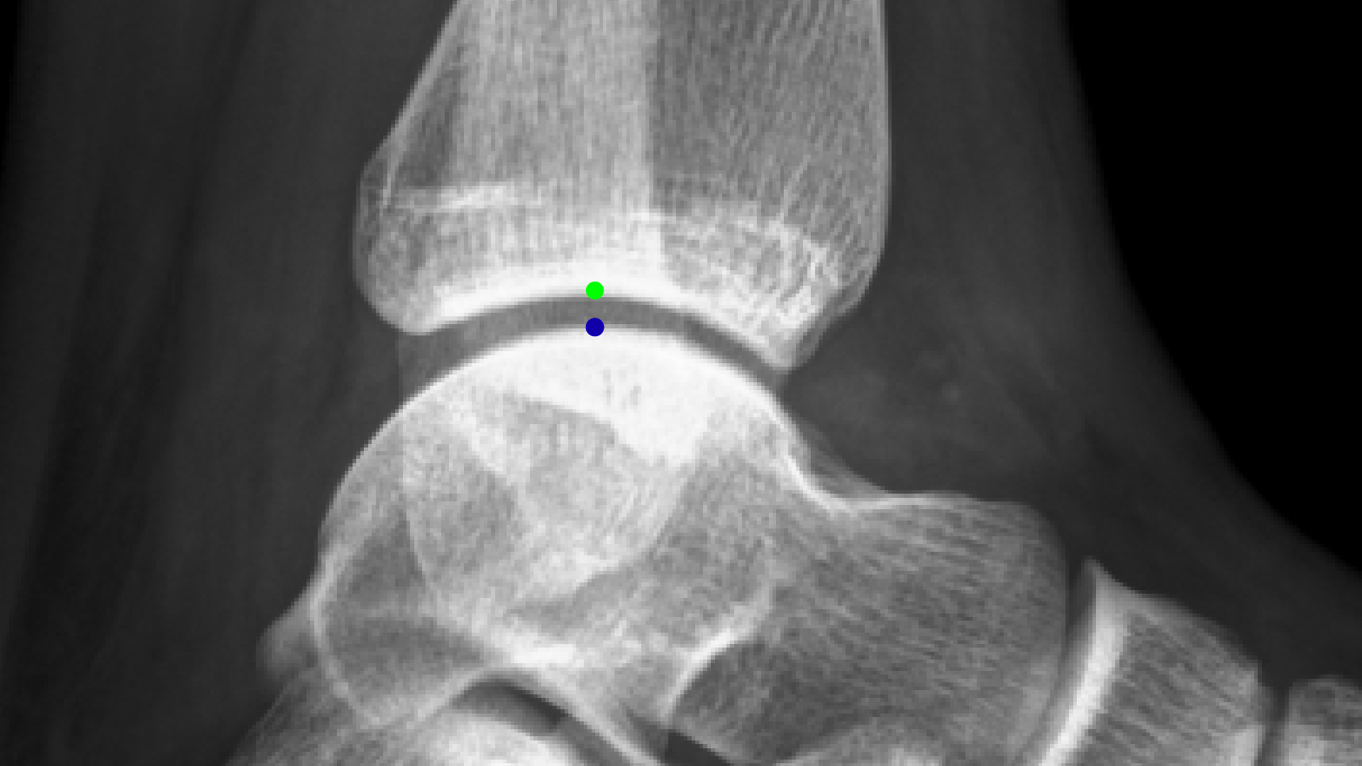 Ankle Xray side view without stress