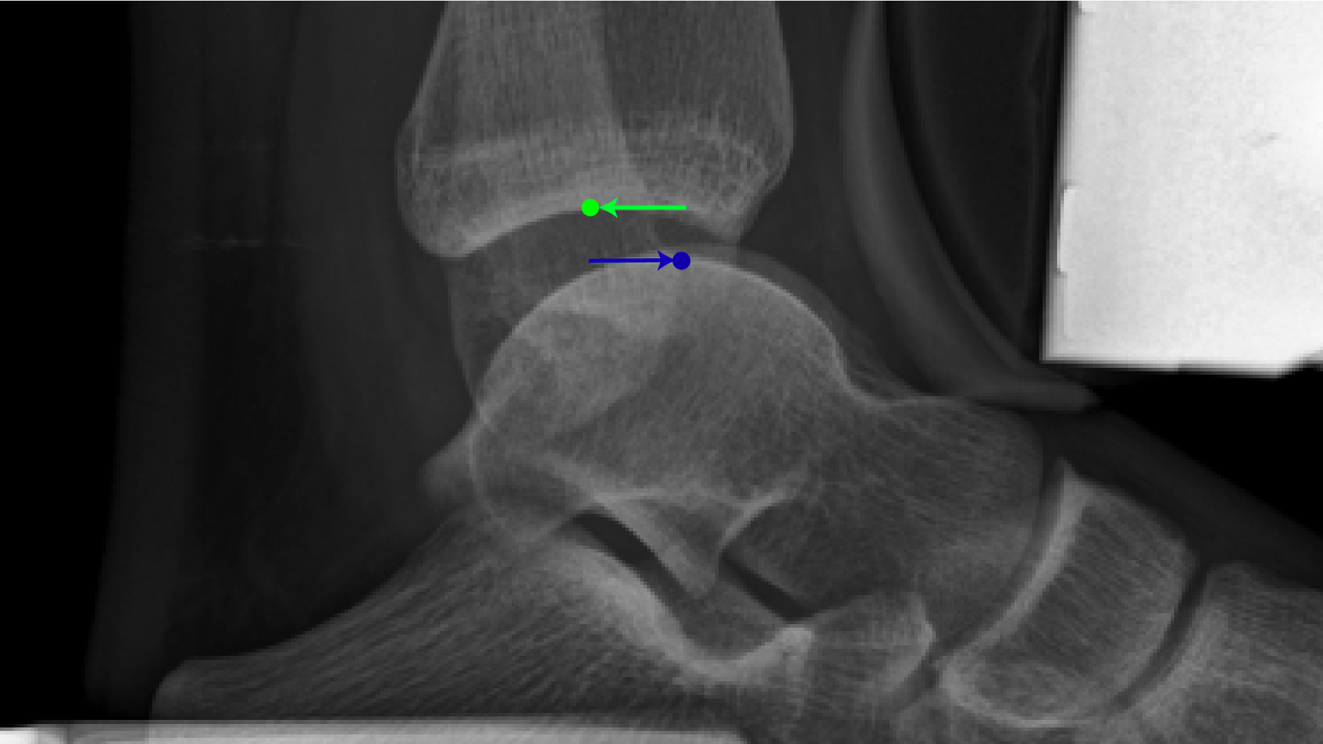 Xray side view under stress