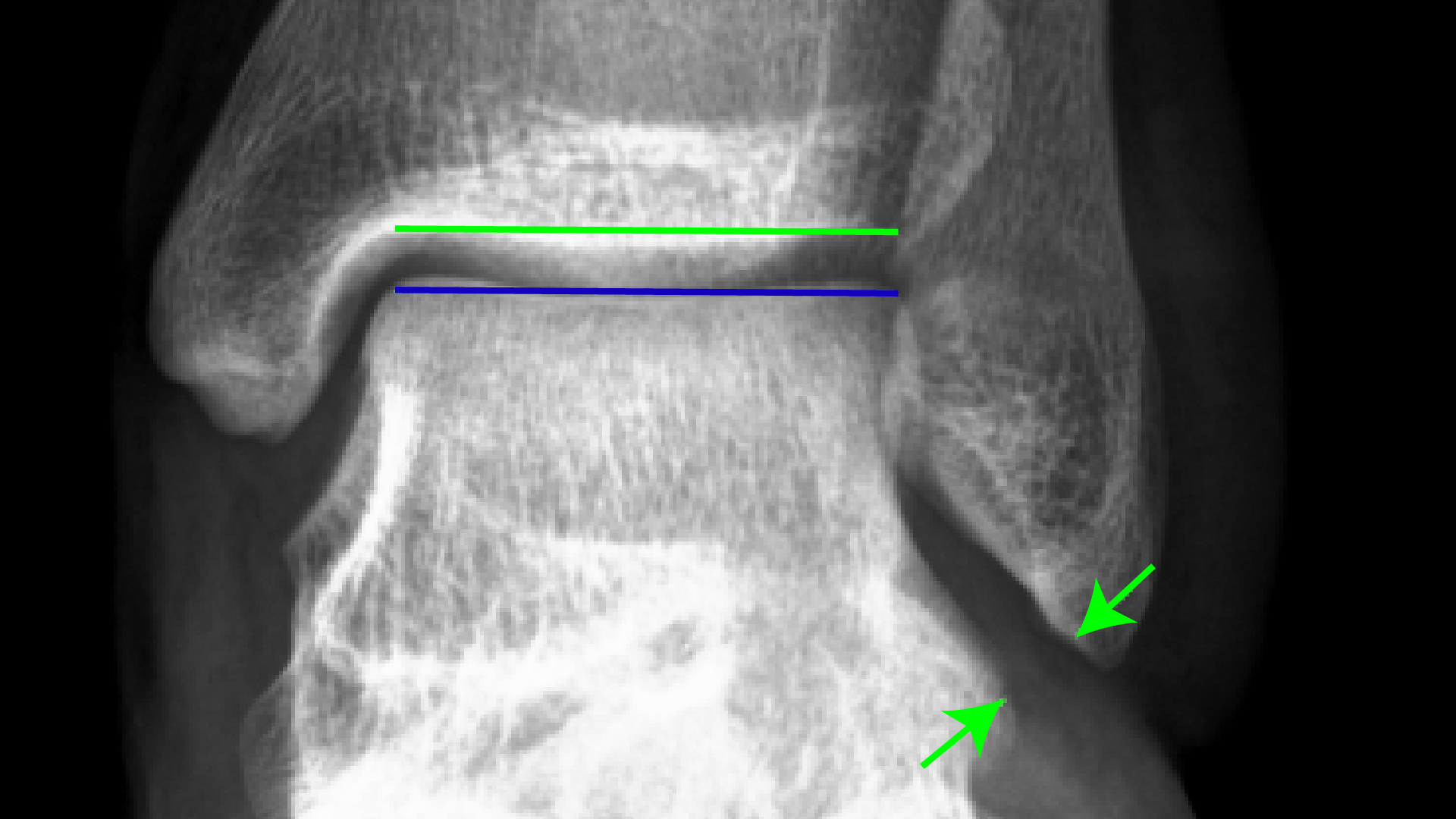 Xray Ankle under stess Telos