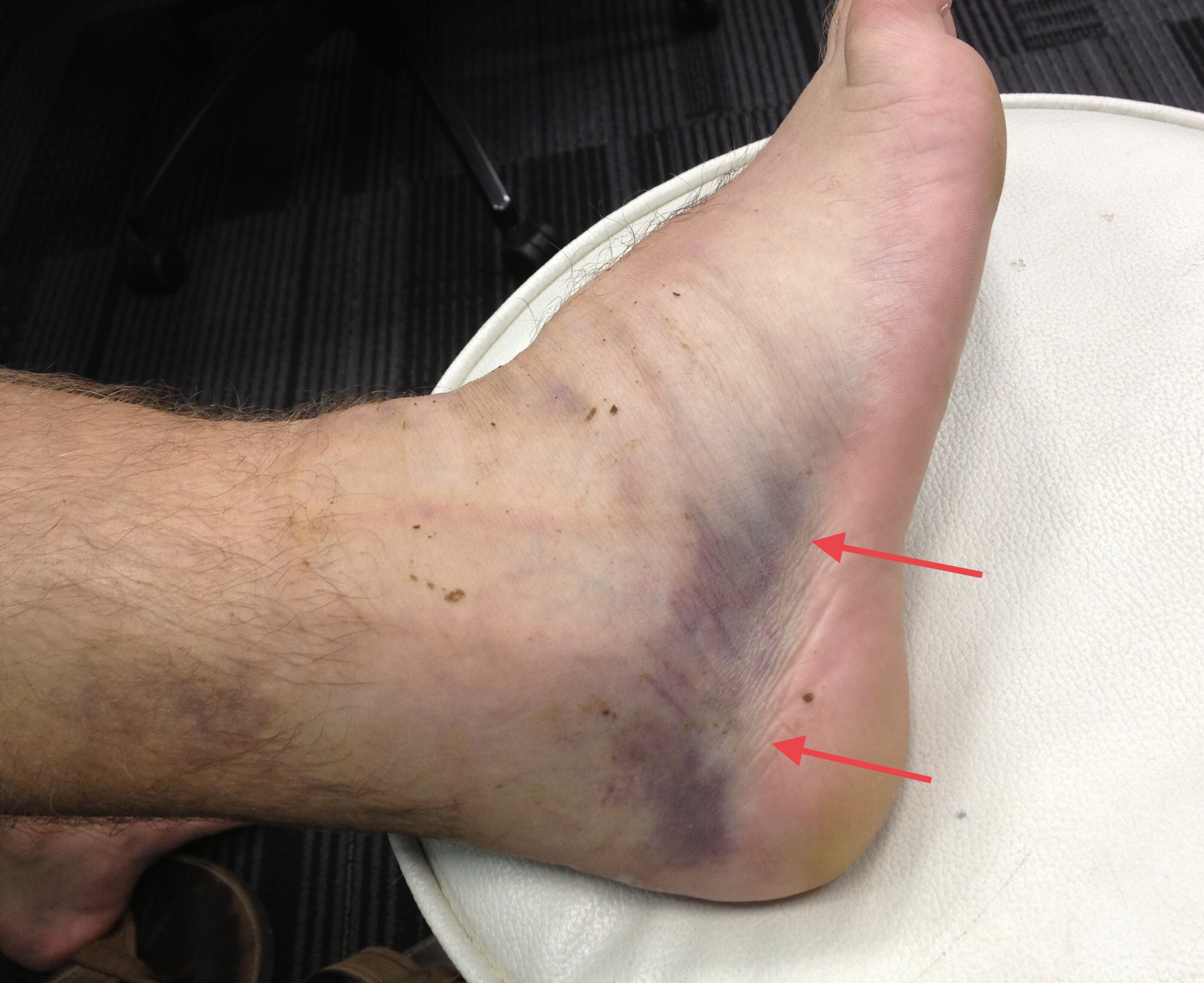 bone bruise ankle