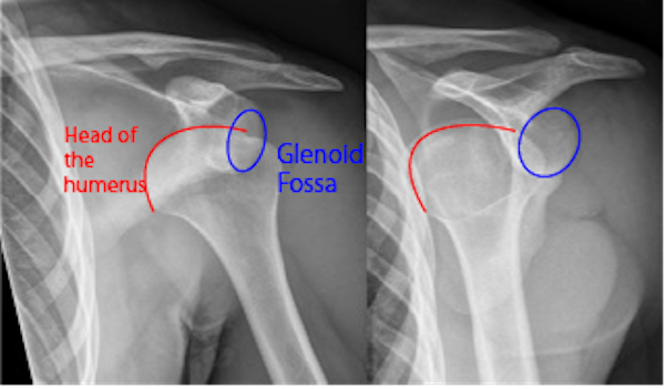 X-ray of a dislocated shoulder