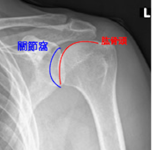 肩關節脫臼常見問題| 肩部| 醫生文章| 亞洲專科醫生