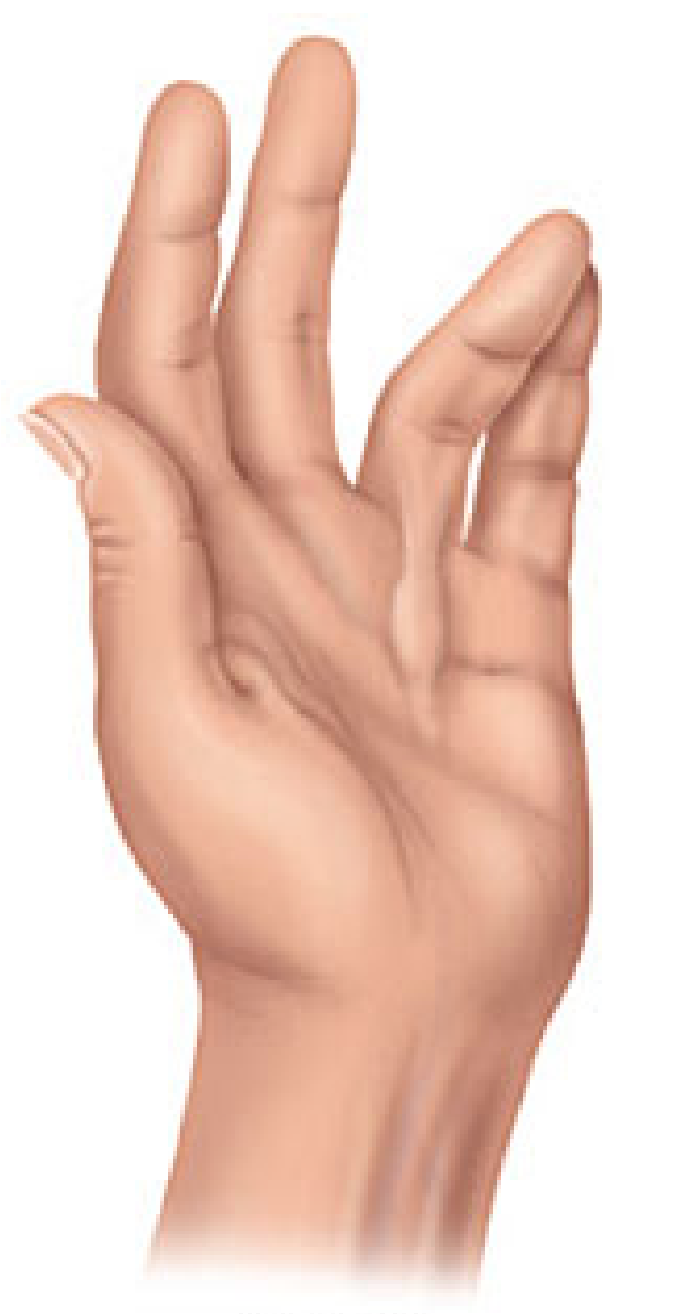 Dupuytrens contracture grade 2