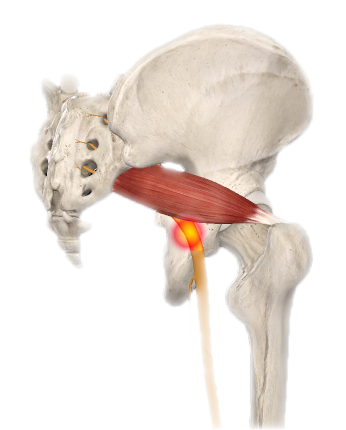 Irritation in the Piriformis muscle that affects the sciatica nerve