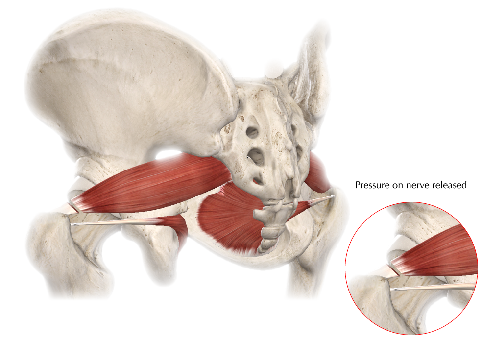 perform incision surgery on Piriformis muscle