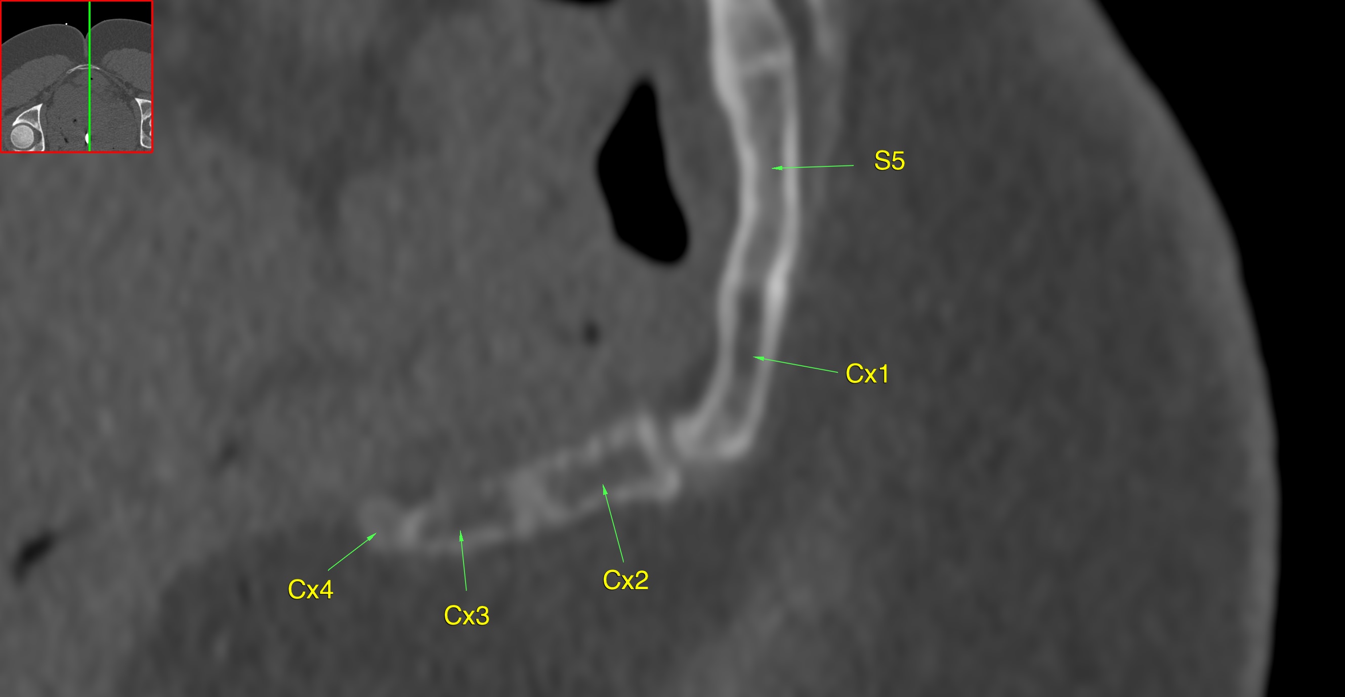 . CT coccyx shows bones in detail. This patient has only one joint &ndash; between Cx 1 and Cx 2. The sacro-coccygeal joint is fused