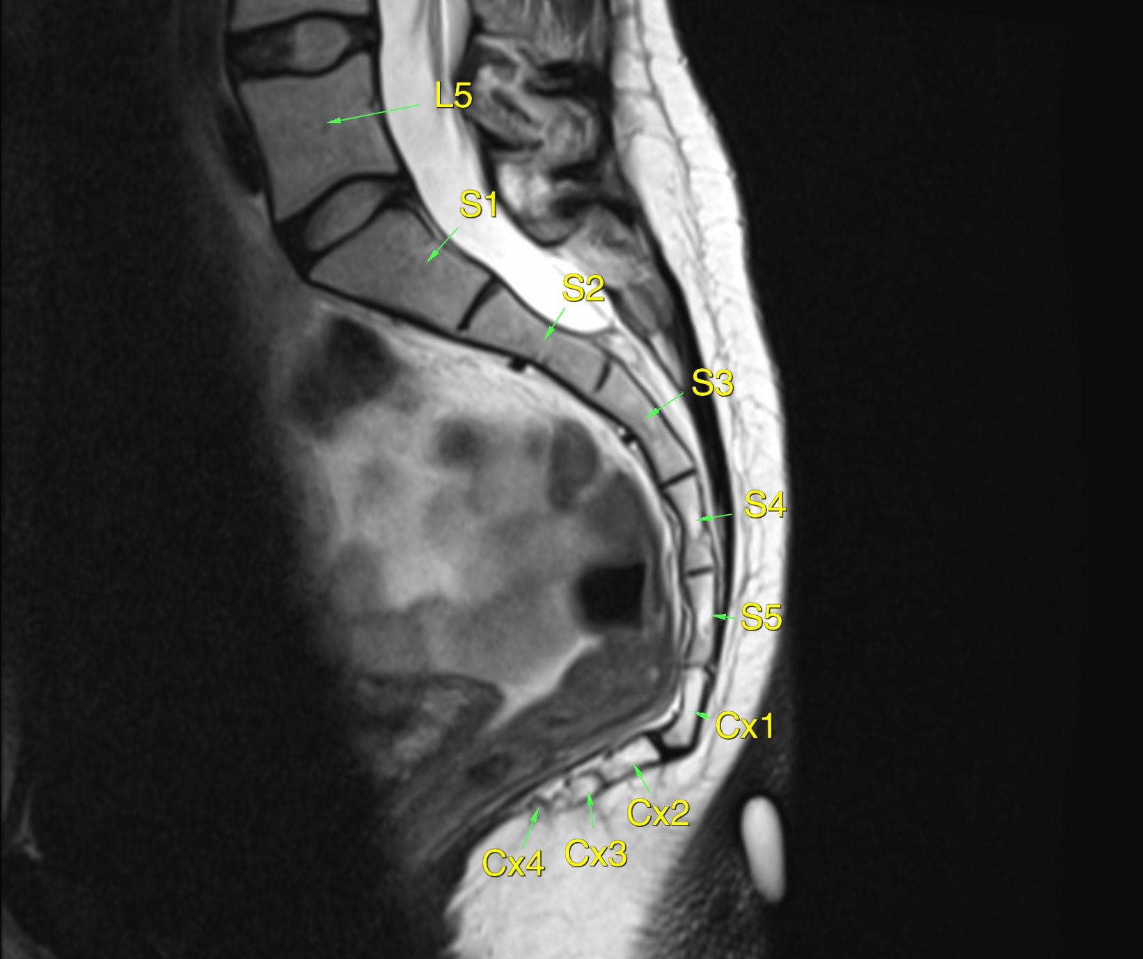 MRI coccyx doesn&rsquo;t show the bones with the high resolution of CT, but shows soft tissues very well. The vertebral bodies are labelled.