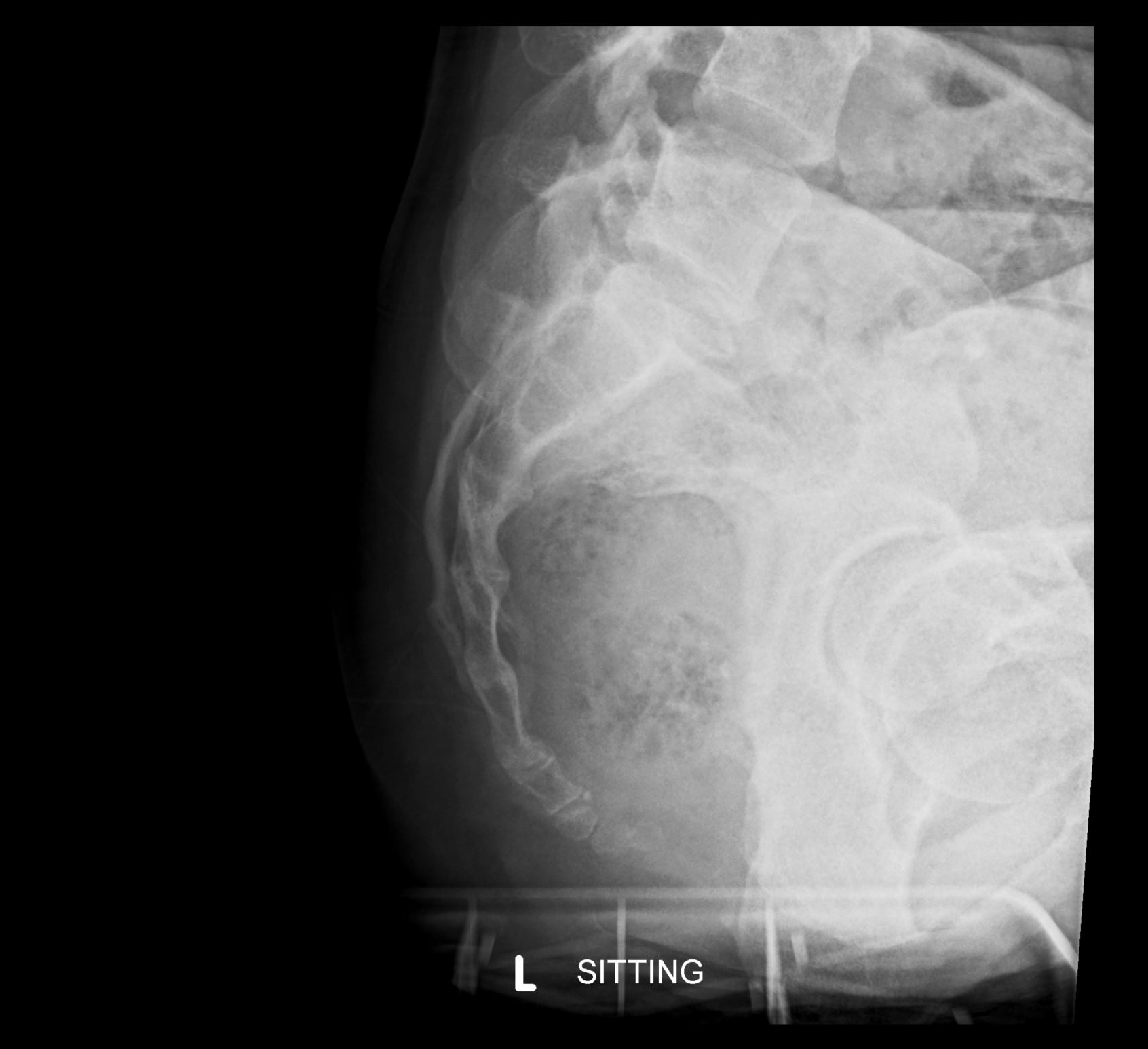 Fig 3. Seated lateral coccyx radiograph.