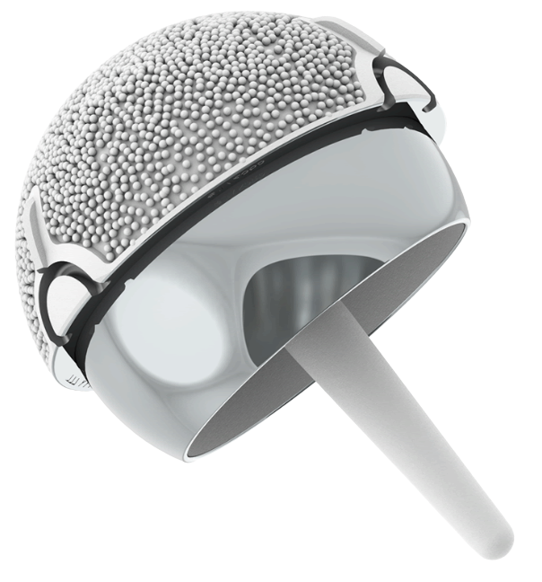 MatOrtho Adept metal-on-metal hip resurfacing